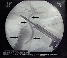 Cholangiogram with labels.jpg