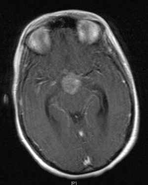 Germinoma, Suprasellar, MRI T1 with contrast, ...