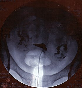 Hysterosalpingogram.jpg