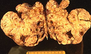 A pathological specimen of ovarian carcinoma Ovarian carcinoma.JPG