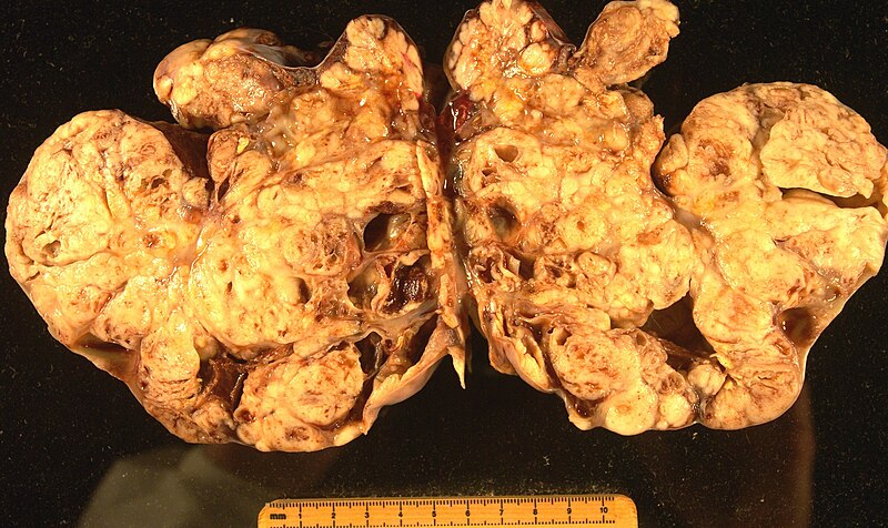 File:Ovarian carcinoma.JPG
