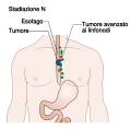 Tumore esofageo con coinvolgimento linfonodale