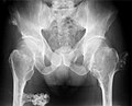 múltiples osteocondromas en la pelvis