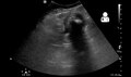 File:UOTW 30 - Ultrasound of the Week 2.webm