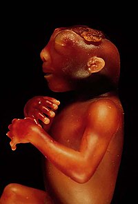 Anencephaly is the most common presentation of neural tube defects Anencephaly side.jpg