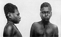 Мужчина с деформированным черепом. Новая Британия, Папуа — Новая Гвинея, начало 1900-х