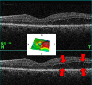 MacularEdema OCT 2-3D LeftE with-out arrows.png