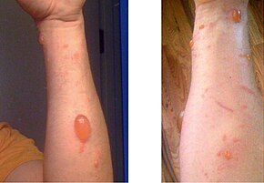 Blisters from contact with poison ivy Urushiol induced contact dermatitis.jpg