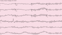 EKG depiction of ventricular fibrillation (no organized rhythm) Ventricular fibrillation.png