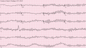 Ventricular fibrillation Ventricular fibrillation.png