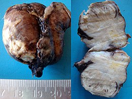 Description de l'image Acute epidydimoorchitis Gross Pathology.jpg.