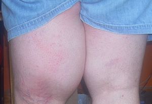 English: Left thigh showing edema caused by li...