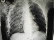 Hemopneumothorax X Ray