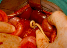 Adult ascaris worms being removed from the bile duct of a patient in South Africa Adult ascaris worms being removed from the bile duct of a patient in South Africa.png