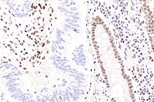 Micrograph showing loss of staining for MLH1 in colorectal adenocarcinoma in keeping with DNA mismatch repair (left of image) and benign colorectal mucosa (right of image). Colorectal adenocarcinoma with MMR - MLH1 -- high mag.jpg