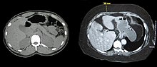 Две изображения от компютърна томография на хоризонтален разрез на средната коремна област; единият от индивида с нормално тегло, другият от затлъстелия човек. И двете костни структури и органи изглеждат сходни. Основната разлика е, че при човек с нормално тегло има малко подкожни мазнини и затлъстелият показва по същество подкожни мазнини.