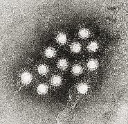 Hepatitis A - Wikipedia, the free encyclopedia