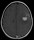 Miniatura para Tumor neuroectodérmico primitivo