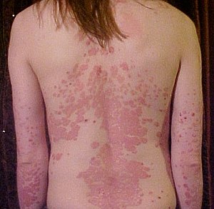 Psoriasis on back1.jpg