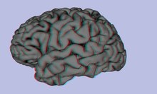 Файл: Стереоскопическая трехмерная визуализация применительно к мультимодальным изображениям головного мозга клиническое видео1.ogv