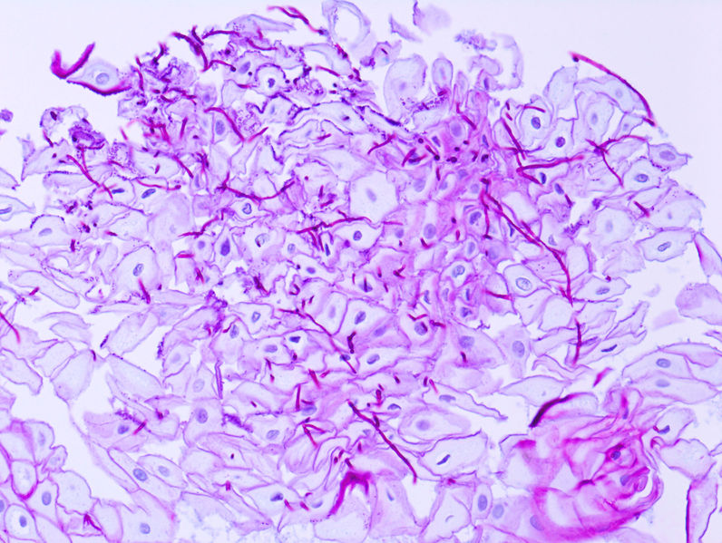 File:Esophageal candidiasis (1) PAS stain.jpg