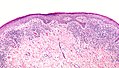 Lichen planus mit Hypergranulose und bandförmigem Infiltrat aus Lymphozyten (niedrige Vergrößerung)