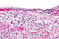Ovariální mucinózní cystadenom - vysoký mag.jpg