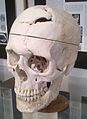 Schädel von Gage, ausgestellt im Warren Anatomical Museum der Harvard Medical School