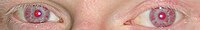 Ojos rojos de una persona albina.
