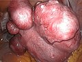 Miniatura para Mioma uterino