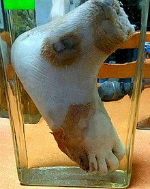 Wet gangrene of the foot. Wet gangrene of the foot.jpg