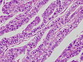 胎児消化管上皮類似癌。左と同症例の別の部位。
