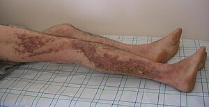 Darier's disease.jpg