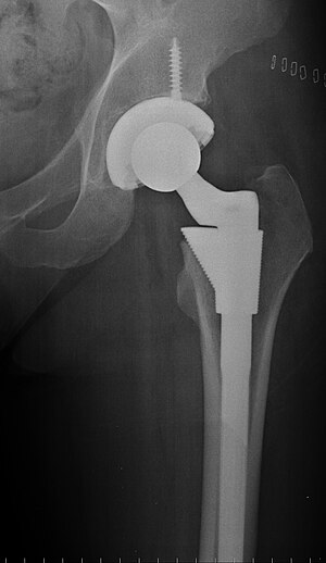 English: Hip replacement using cementless impl...
