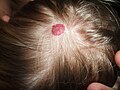 ورم وعائي دموي على فروة الرأس لمريضة أنثى عمرها سنتين وتظهر في مرحلة الركود أو الراحة.