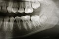 Zawiązek zęba 38