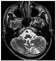 Die axiale MRT des Gehirns eines 27-jährigen Morbus-Fabry-Patienten mit ischämischem Schlaganfall zeigt den Schlaganfall in der linken zerebellären Hemisphäre. Der Patient wies sonst keine Symptome der Erkrankung auf.