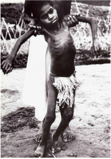 Dítě z kmene Fore v pokročilém stádiu nemoci kuru