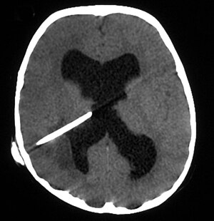 Mozkový absces jednoduchý mozek CT.jpg