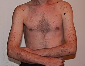 صورة لشخص مصاب بالتسحج العصبي مع ظهور تقرحات في جلده نتيجه للحك والشد