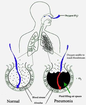 Pneumonia fills the lung's alveoli with fluid, hindering oxygenation. The alveolus on the left is normal, whereas the one on the right is full of fluid from pneumonia. New Pneumonia cartoon.jpg