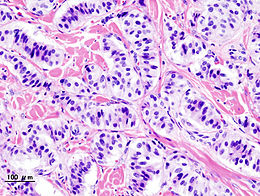 Description de l'image Pancreatic insulinoma (2).JPG.