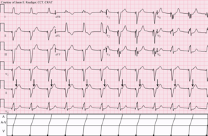 V-крачка с 1 към 1 retroconduction.png