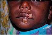 A symptom of Yaws disease