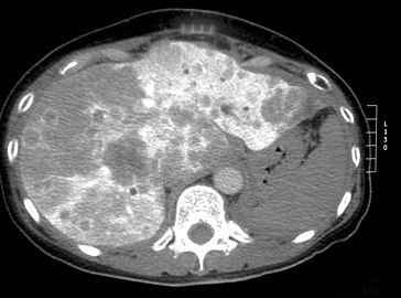 大肠癌肝部断层扫描