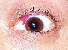 A subconjunctival hemorrhage is a common and minor post-LASIK complication. Eye hemorrhage.jpg