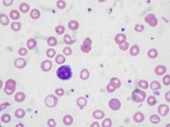English: Peripheral blood film of a patient wi...