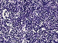 Микрофотография мелкоклеточного рака простаты.jpg
