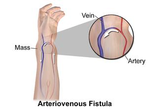 Blausen 0049 ArteriovenousFistula.png