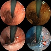 印環細胞を伴う低分化型腺癌の内視鏡像。通常内視鏡像に加え強調画像と色素内視鏡像。左上：通常内視鏡像、右上：通常＋FICE、左下：酢酸染色、右下：AIM染色